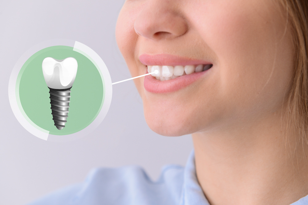インプラントと差し歯の違い｜あなたに適した治療はどっち？