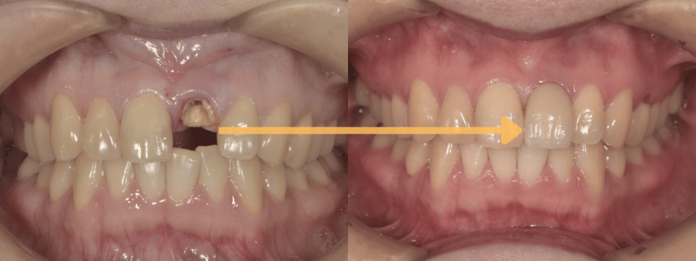 前歯のインプラント症例1
