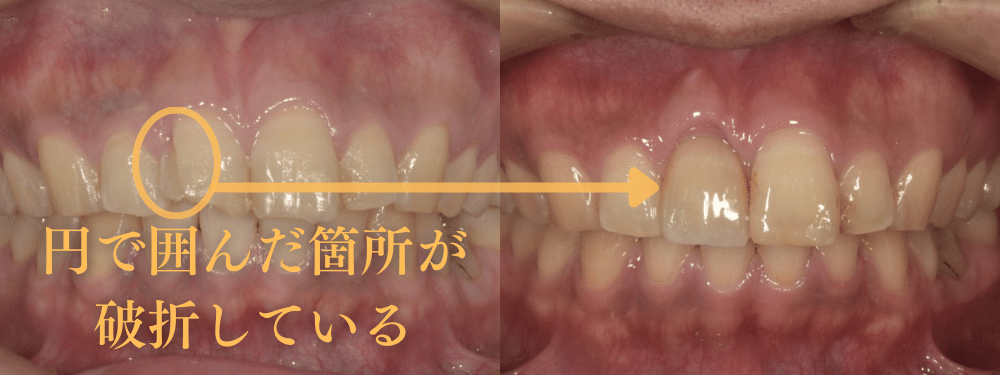前歯のインプラント症例2 