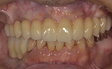 症例２ インプラン治療による全顎的な噛み合わせを回復した症例