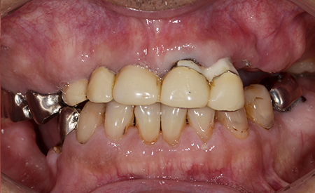 症例２ インプラン治療による全顎的な噛み合わせを回復した症例