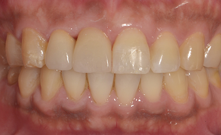 症例３　前歯部の抜歯即時インプラント症例