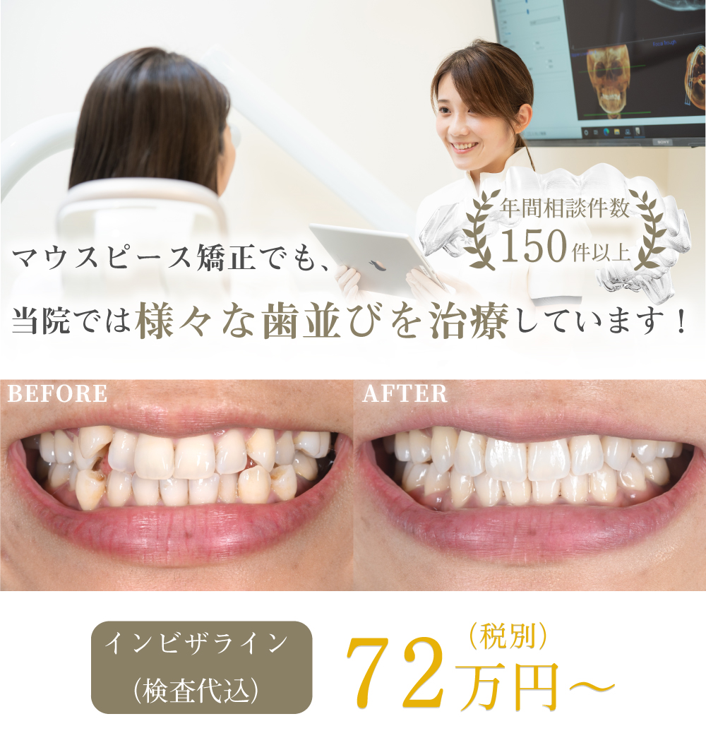 明石でインビザライン（マウスピース矯正）