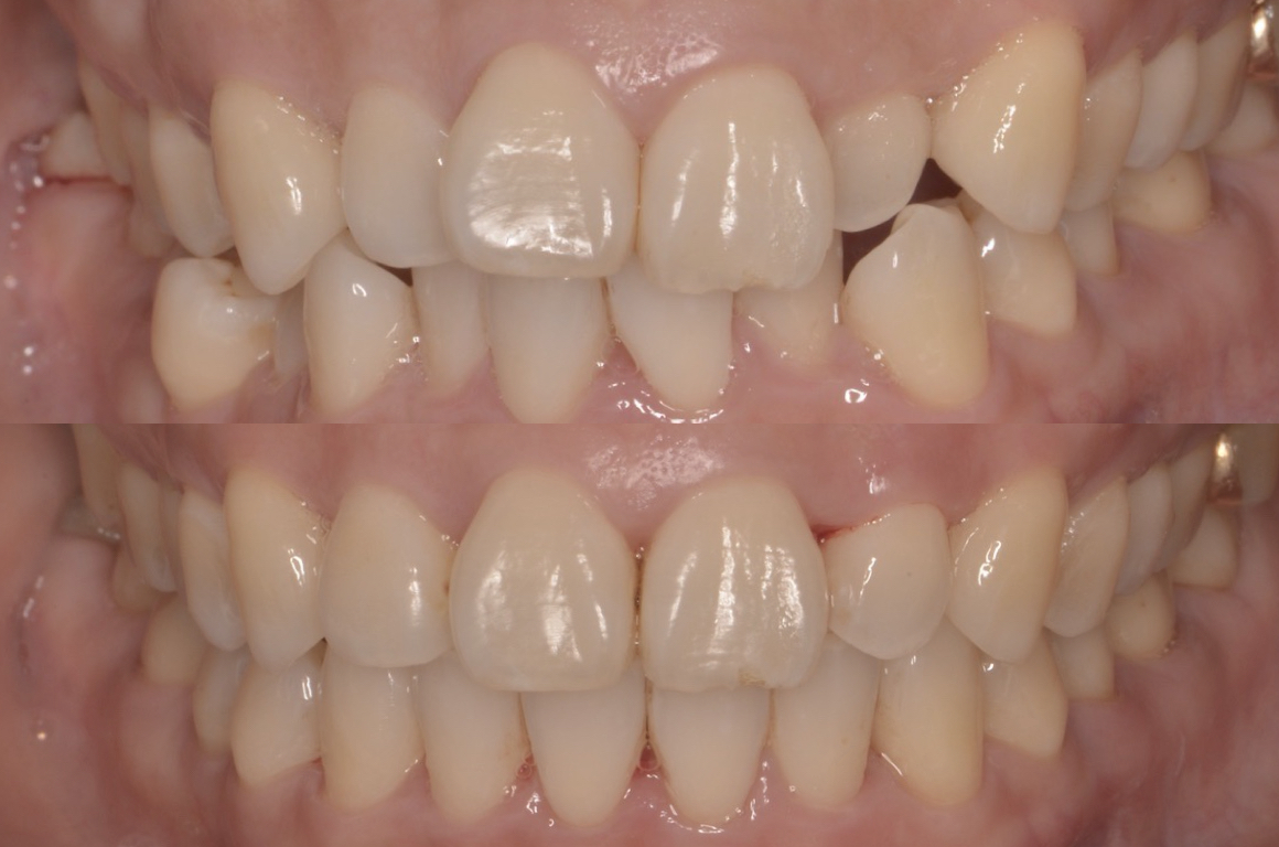 141前歯部叢生（前歯のガタガタ）および上顎３番の唇側転位（八重歯）を矯正治療にて治療して症例