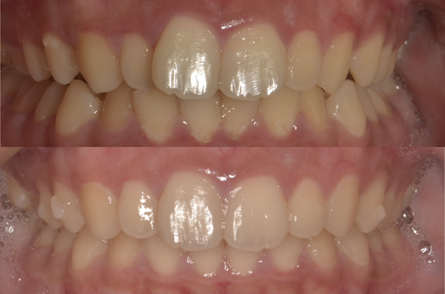 165前歯部叢生（前歯のガタガタ）および上顎３番の唇側転位（八重歯）を矯正治療にて治療して症例