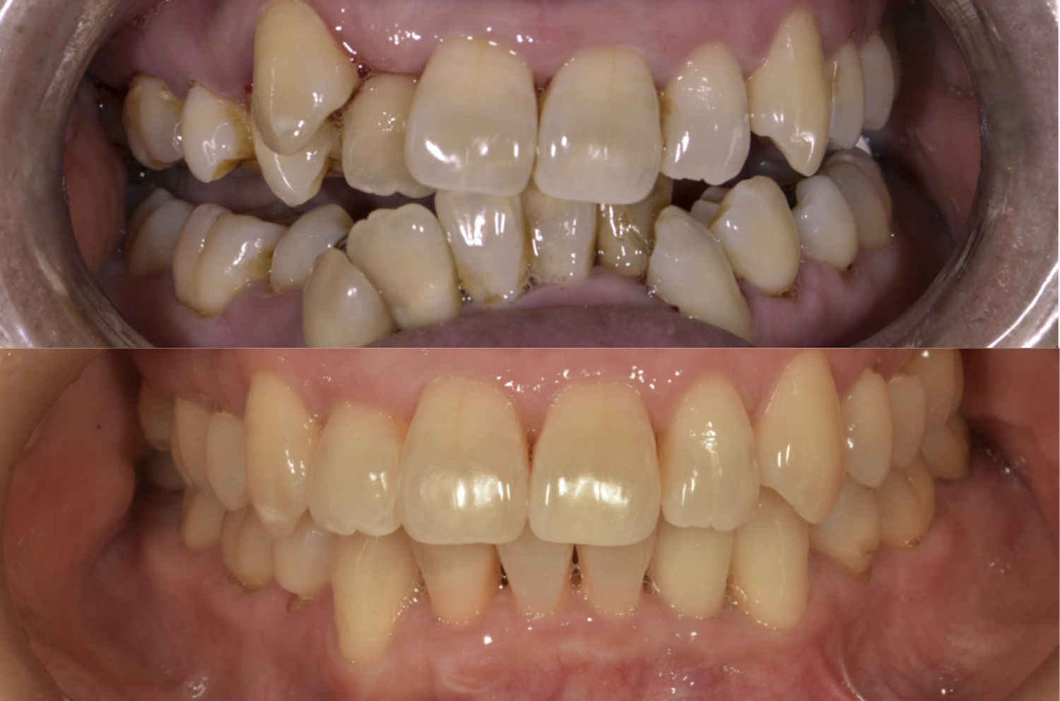 前歯部叢生（前歯のガタガタ）および上顎３番の唇側転位（八重歯）を矯正治療にて治療して症例