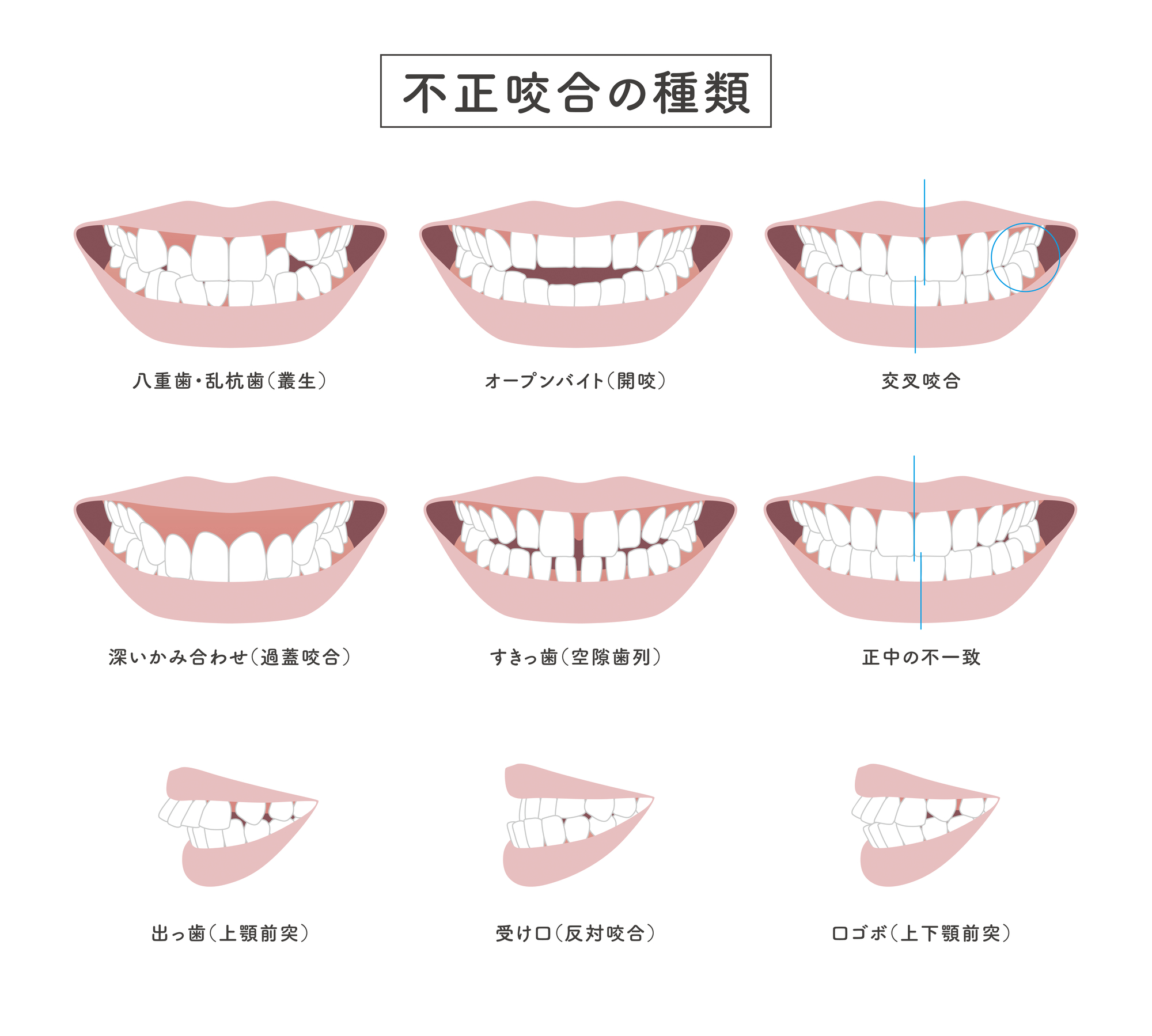 マウスピース矯正(インビザライン)で治療可能な歯並び