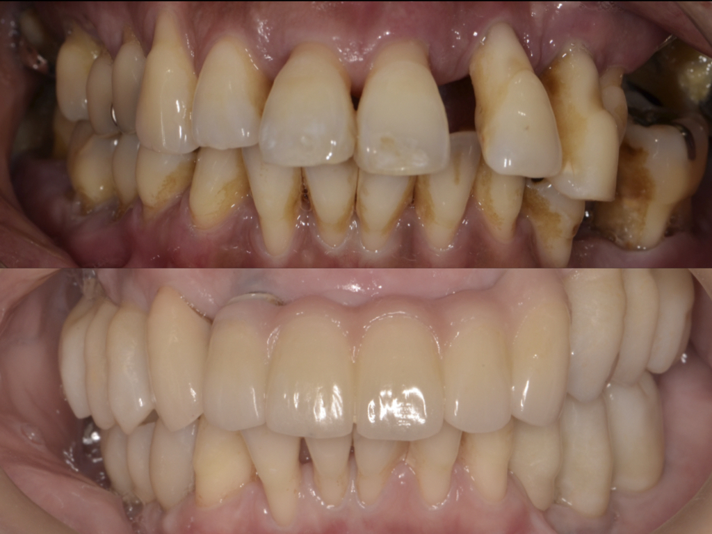 318銀歯をダイレクトボンディングにより治療した（白くした）症例