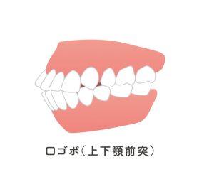 口ゴボ（上下顎前突）の治療法