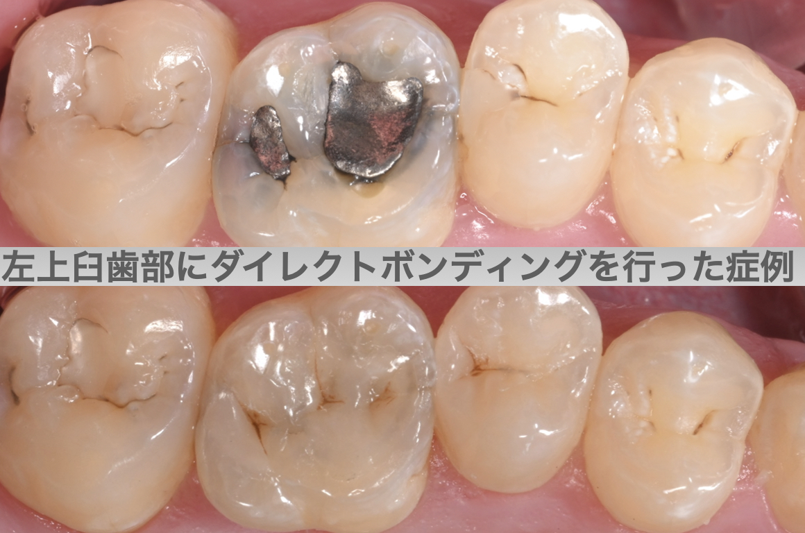 831左上臼歯部セラミックインレーの症例（セラミックによる白い詰め物）