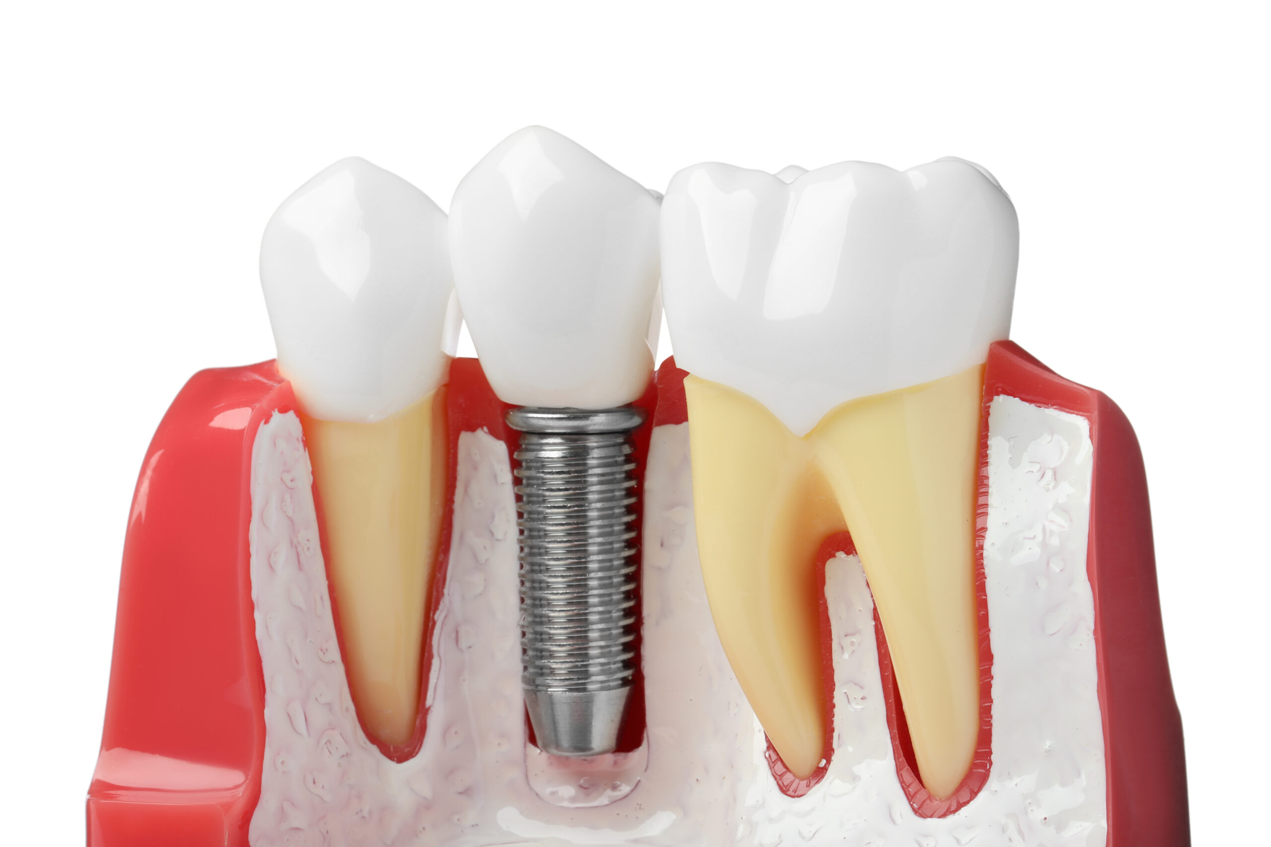 921歯の神経の治療期間について