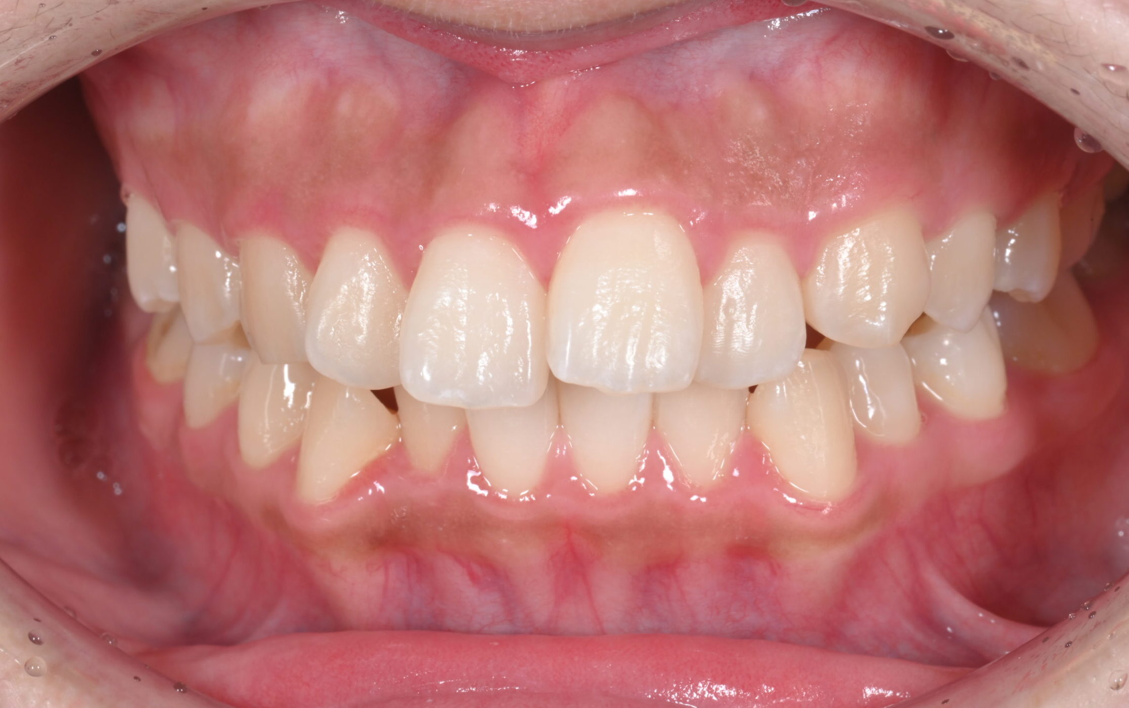 前歯部の叢生（前歯のガタガタ）を主訴にご来院された方の矯正相談内容