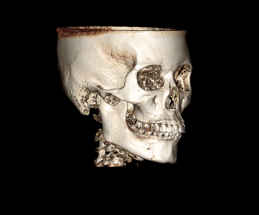 1268前歯部の叢生（前歯の１本のガタガタ）を主訴に来院された方の矯正治療について