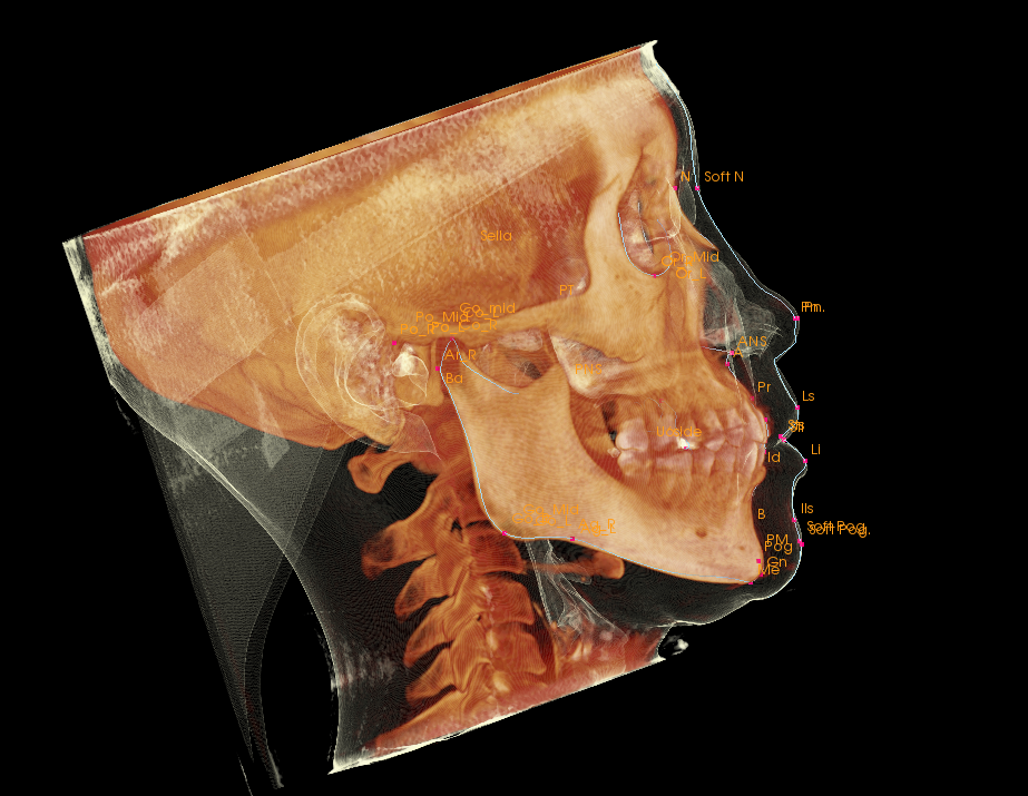 1279下顎前歯部の叢生（下の前歯のガタガタ）を主訴に来院された方の矯正治療について