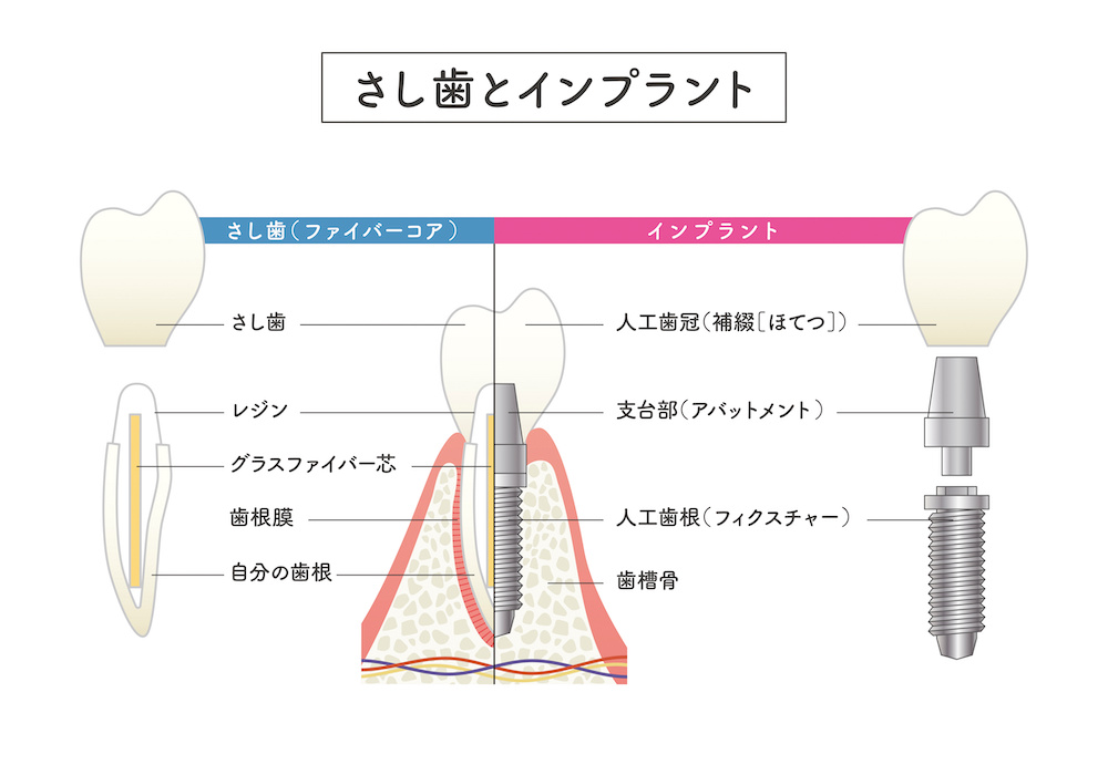 インプラントと差し歯の違い｜あなたに適した治療はどっち？