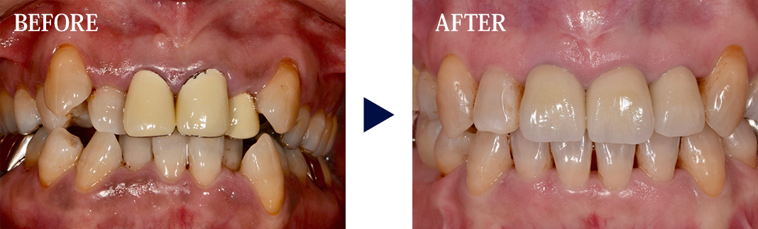 歯の形や色を美しくする治療も合わせて行う事ができます