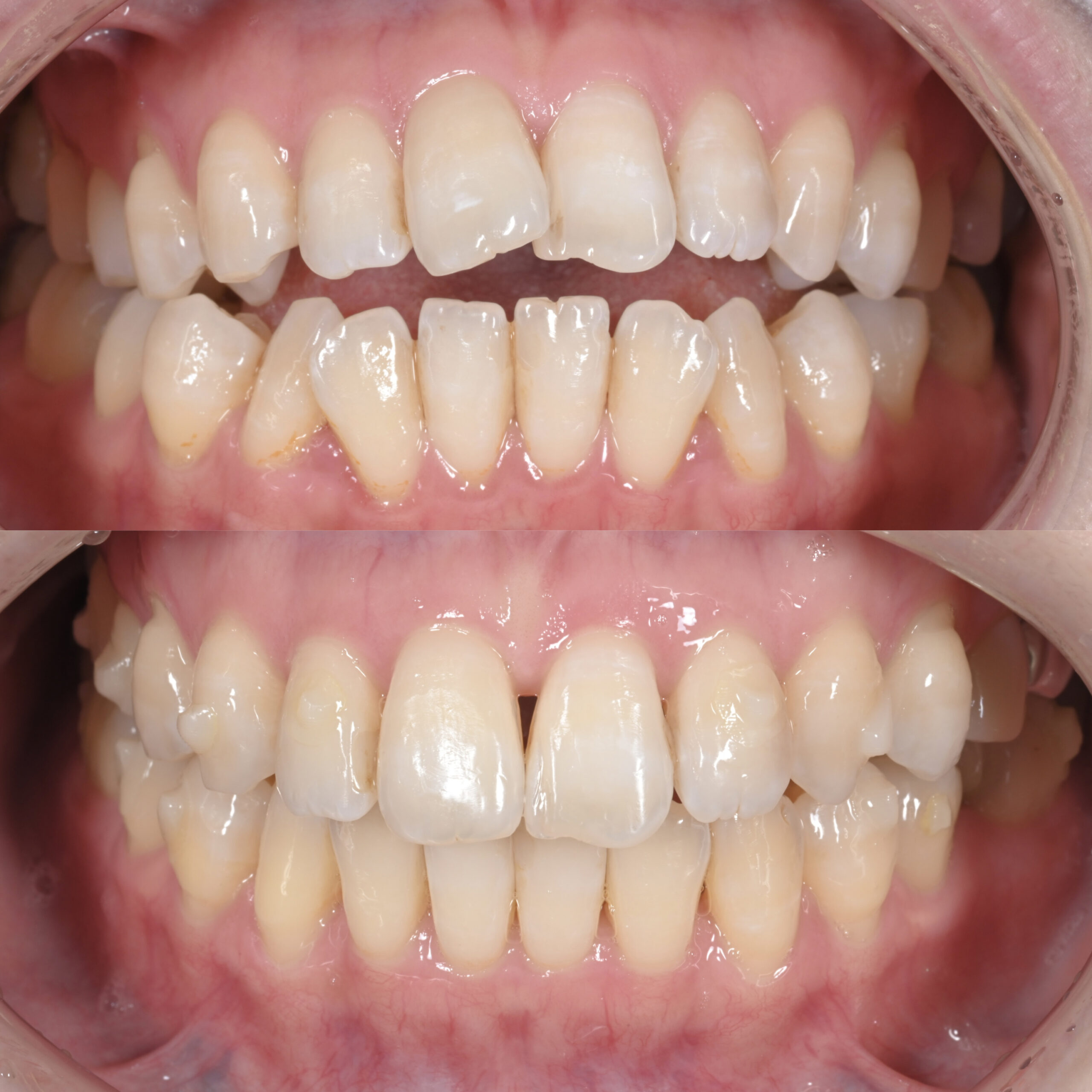 前歯部開咬をインビザライン（マウスピース矯正）で治療した症例