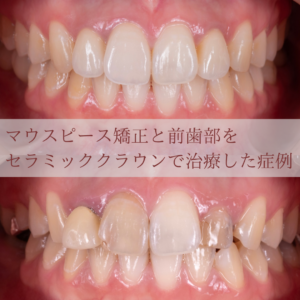 1807【精密根管治療】40代女性　主訴：右下の奥歯から膿が出る