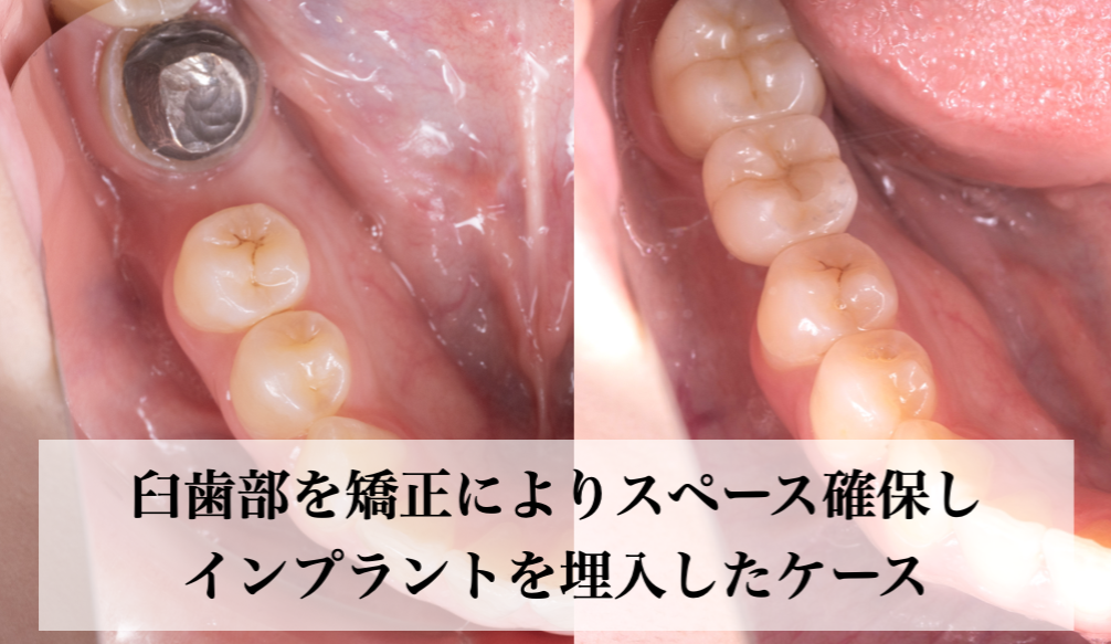 傾斜した臼歯部を矯正で戻してスペース確保し インプラントを埋入した症例