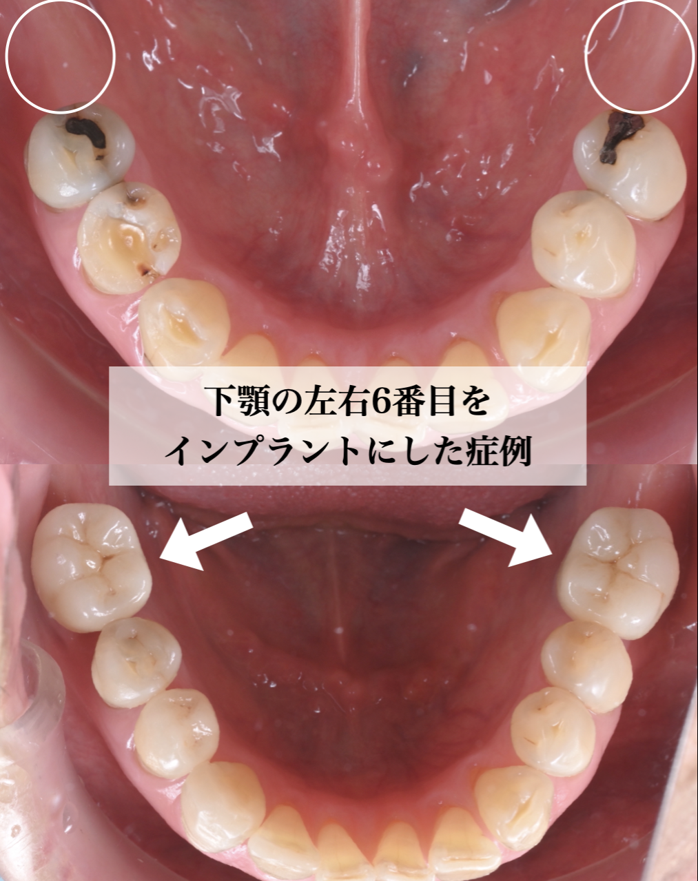 下顎の左右6番目をインプラントにした症例