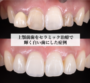 1948倒れた奥歯を矯正で治しインプラントを埋入した症例