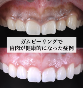 ガムピーリングで歯肉が健康的になった症例
