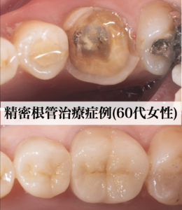 1868【精密根管治療】40代女性　主訴：右下の奥歯から膿が出る