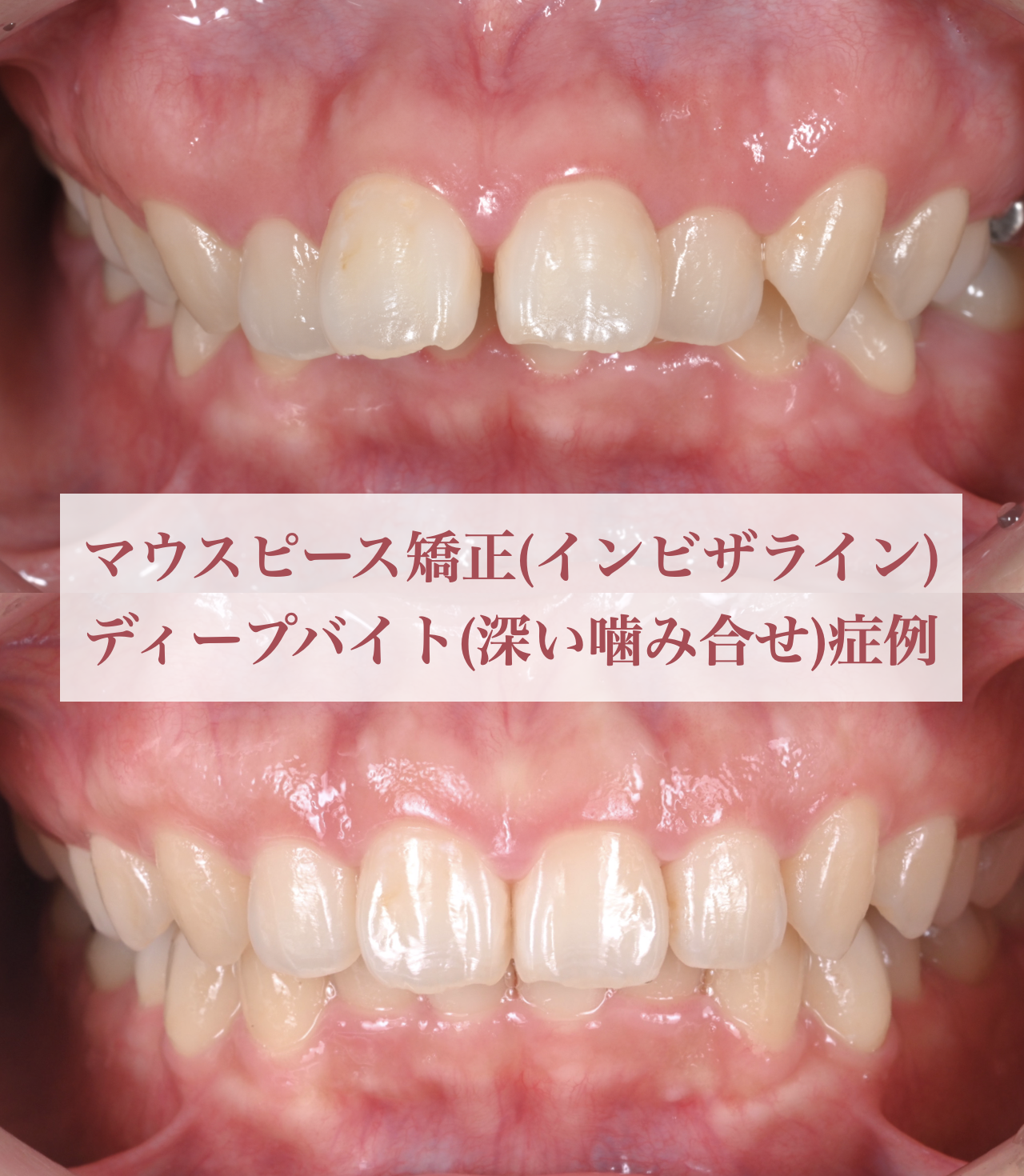 マウスピース矯正(インビザライン) でディープバイト(深い噛...