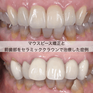2078ラミネートベニア2歯で劇的に印象が変わった症例