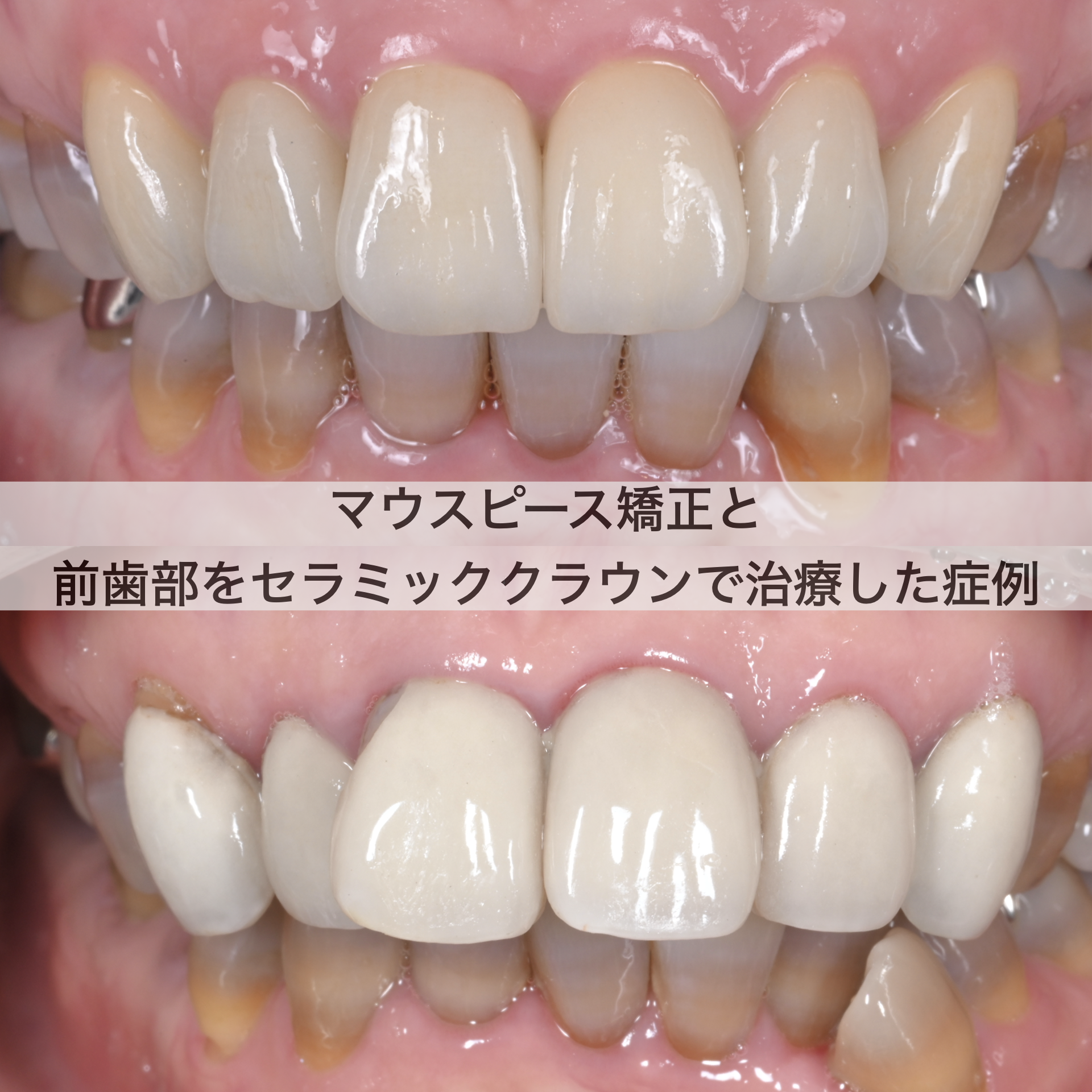 マウスピース矯正（インビザライン）と前歯部をセラミッククラウンで治療した症例