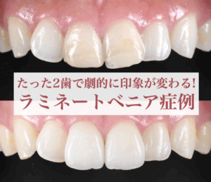 2097マウスピース矯正（インビザライン）と前歯部をセラミッククラウンで治療した症例