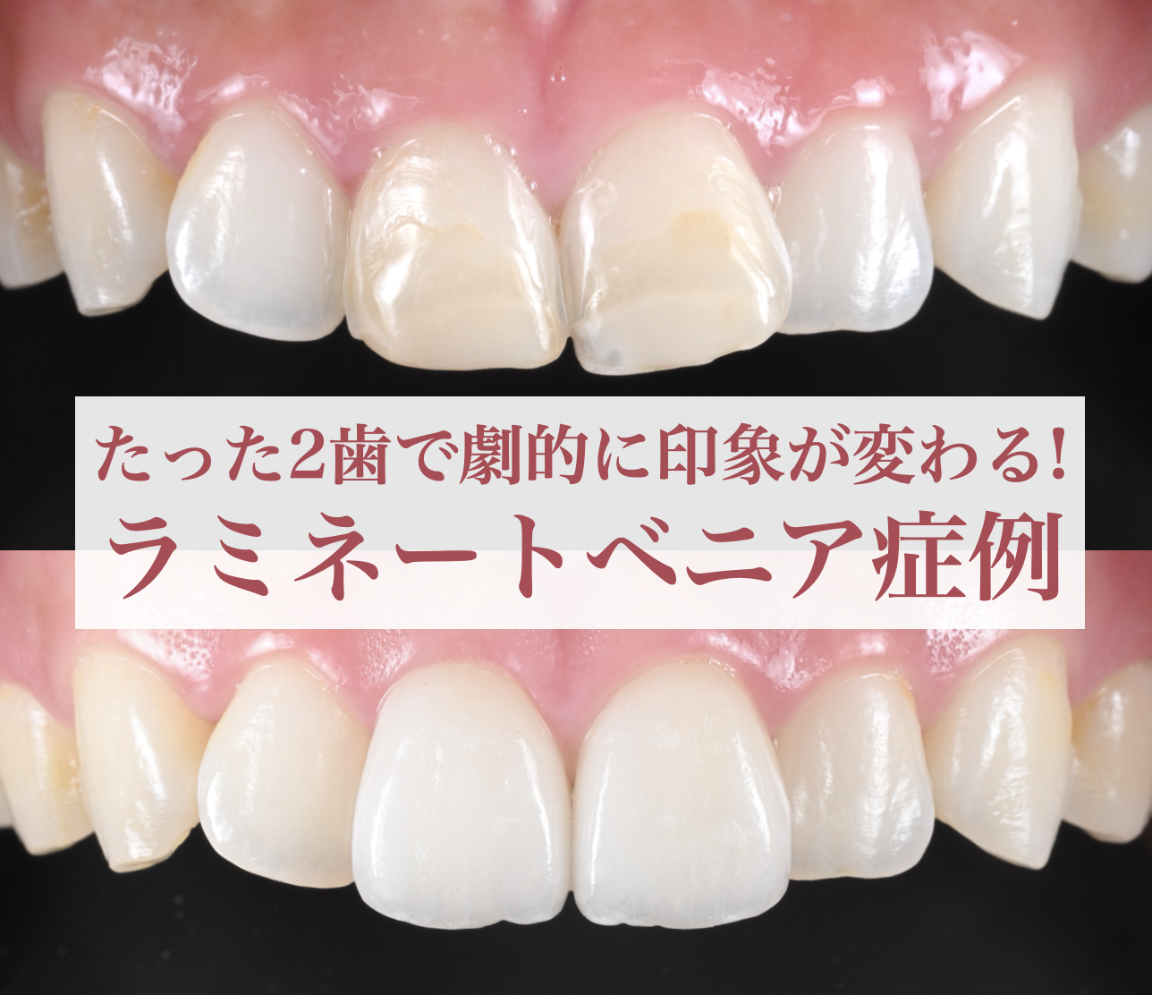 ラミネートベニア2歯で劇的に印象が変わった症例