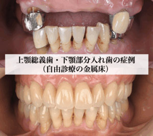 2110ラミネートベニア2歯で劇的に印象が変わった症例