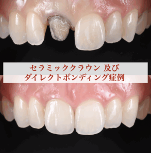 セラミッククラウン及びダイレクトボンディングによる審美症例