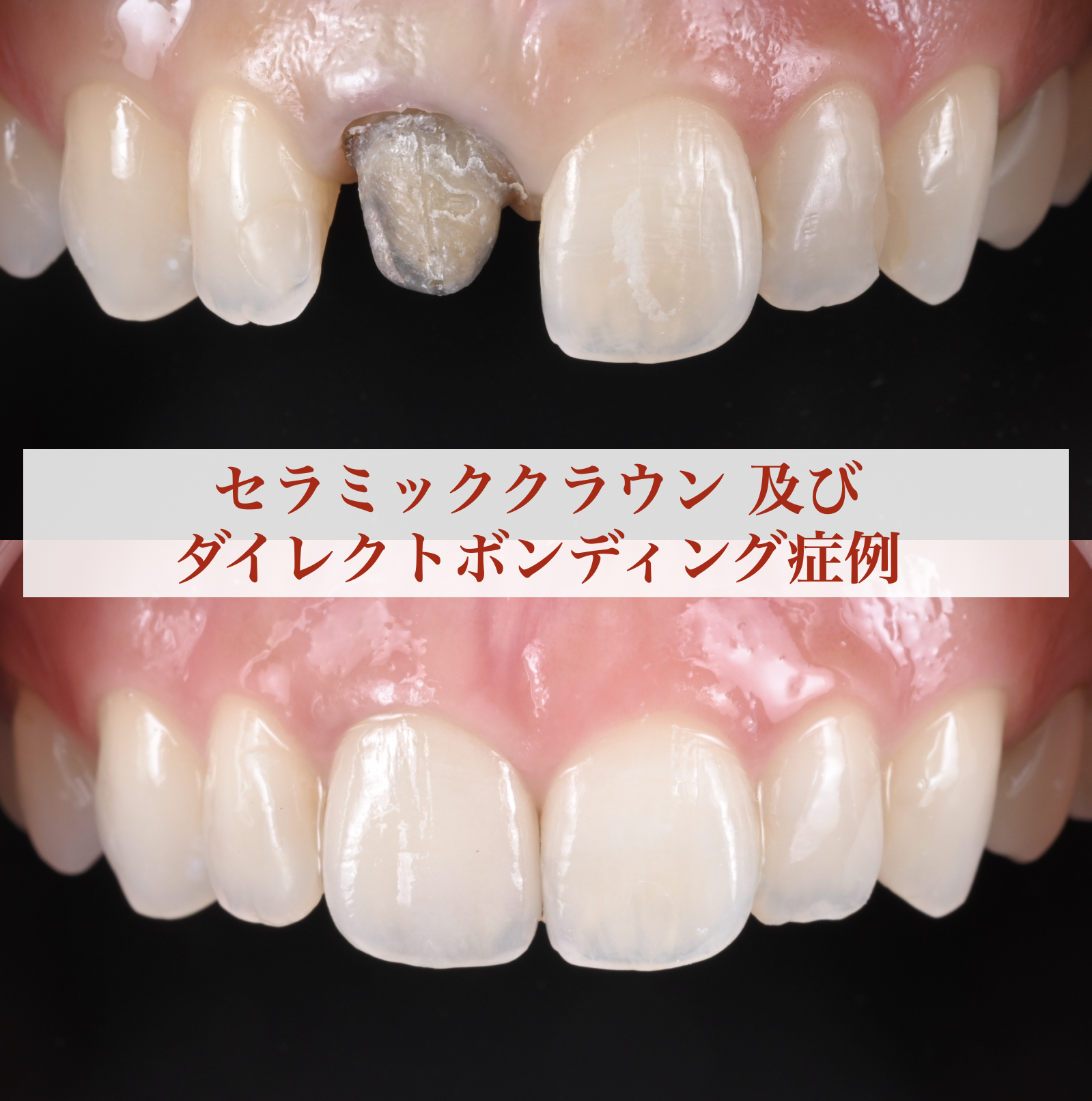 セラミッククラウン及びダイレクトボンディングによる審美症例