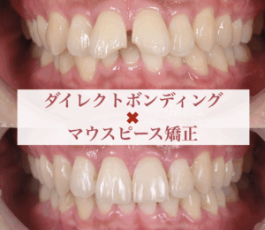 ダイレクトボンディング×マウスピース矯正症例