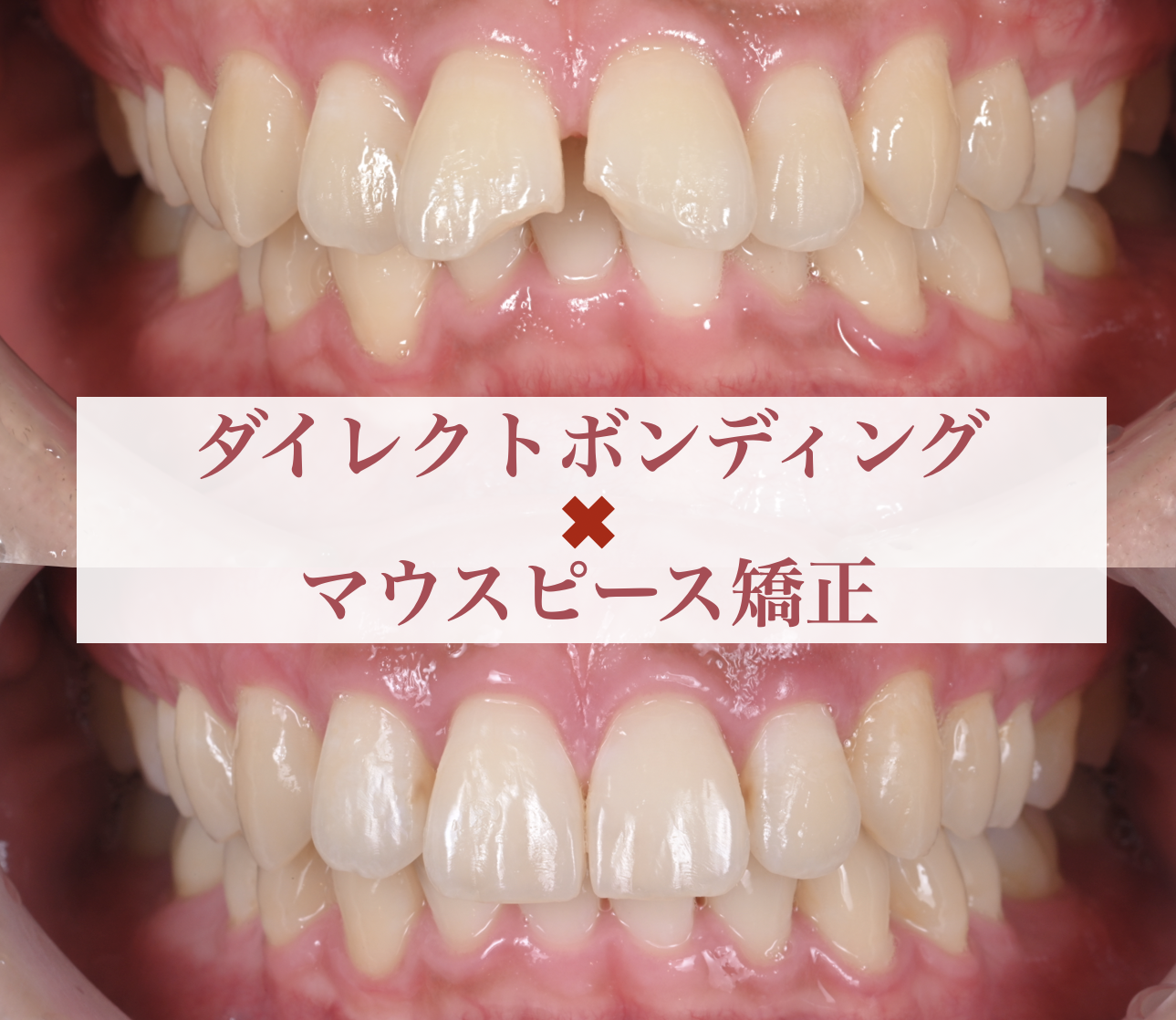 ダイレクトボンディング×マウスピース矯正症例
