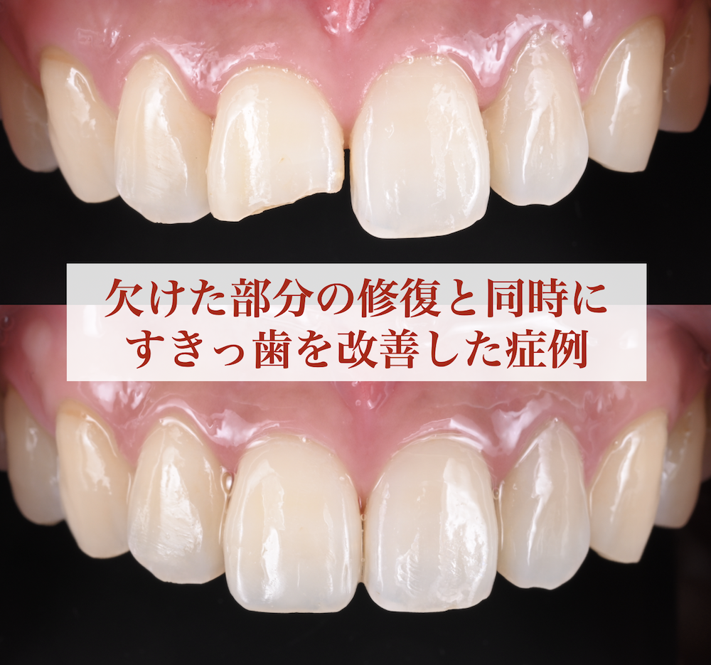 欠けた部分の修復と同時にすきっ歯を改善した症例