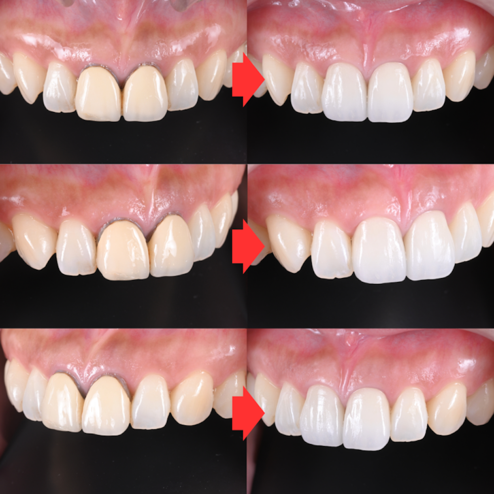 セラミッククラウンによる上顎前歯部の審美症例
