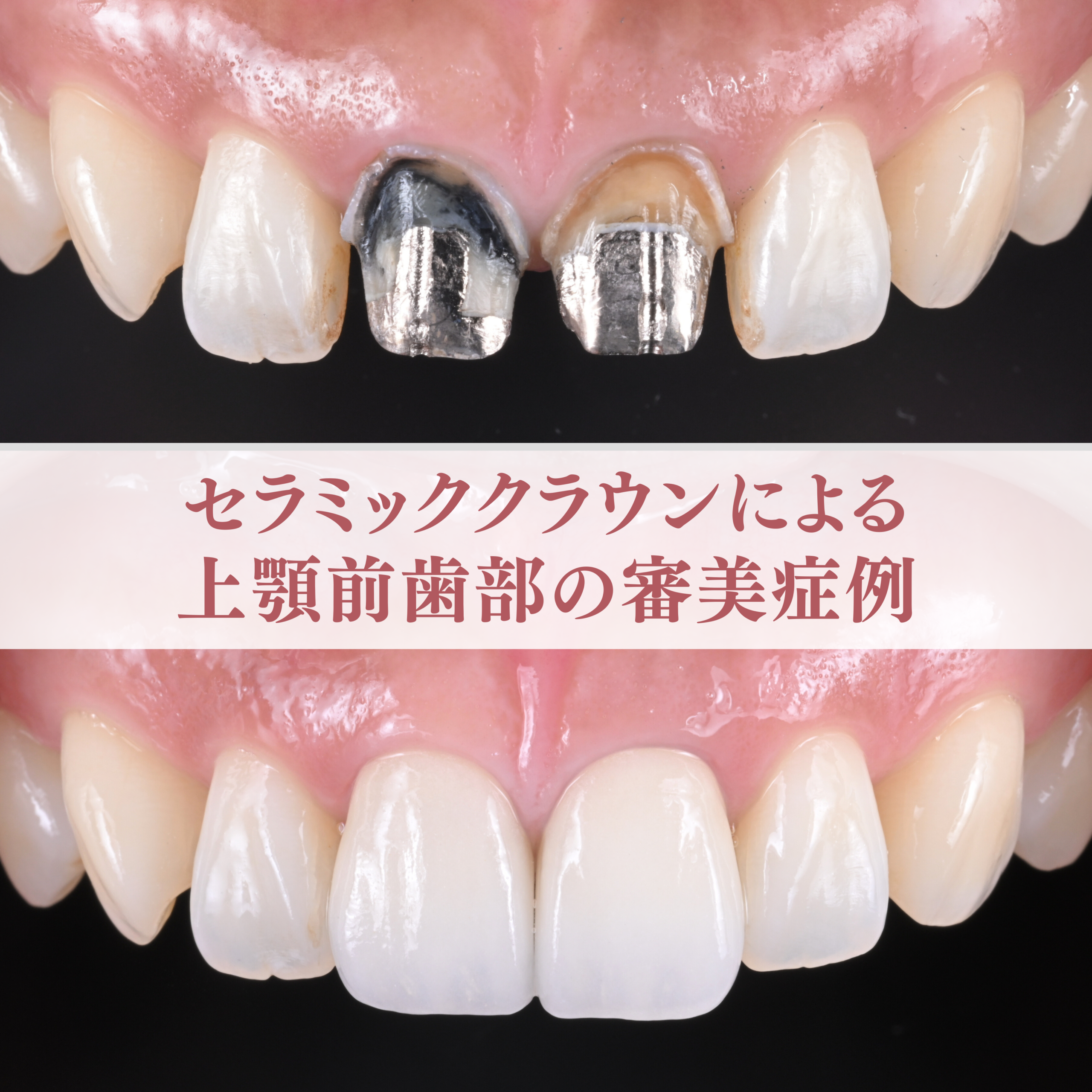 セラミッククラウンによる上顎前歯部の審美症例