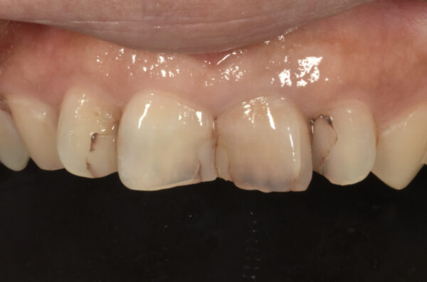 前歯の虫歯治療で見た目を整える方法