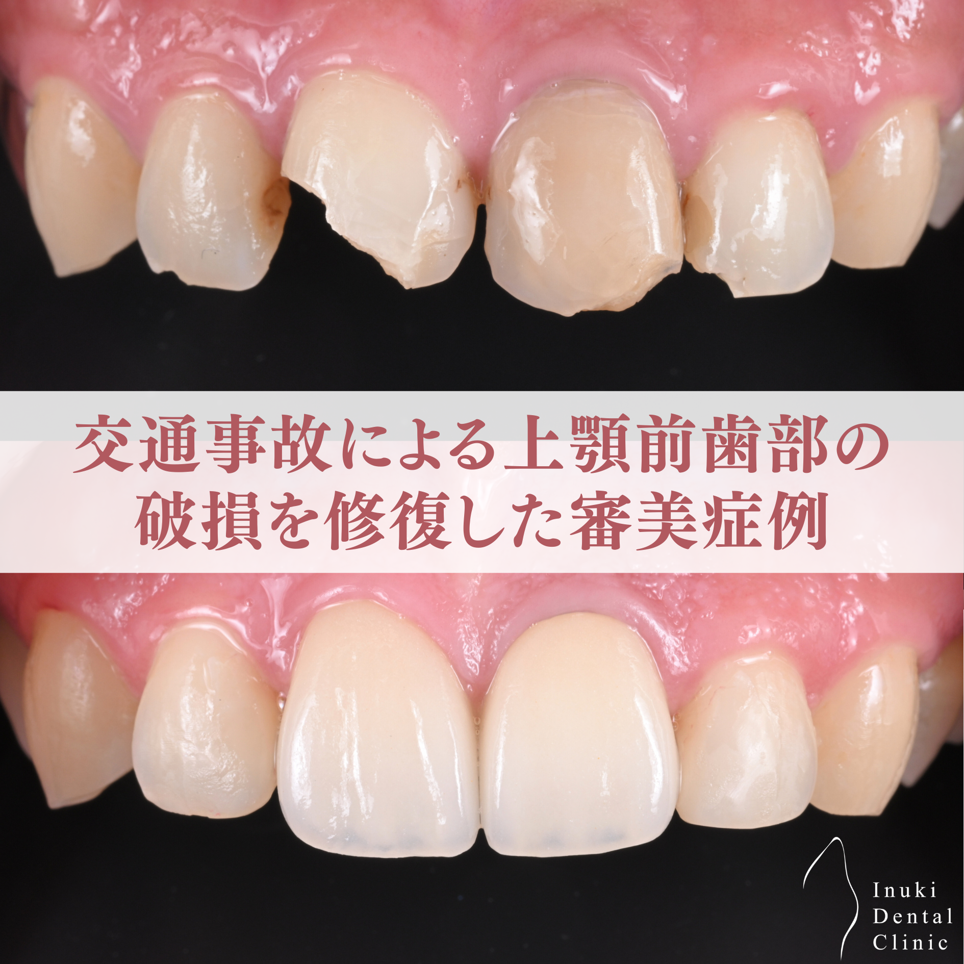交通事故による上顎前歯部の破損を修復した審美症例