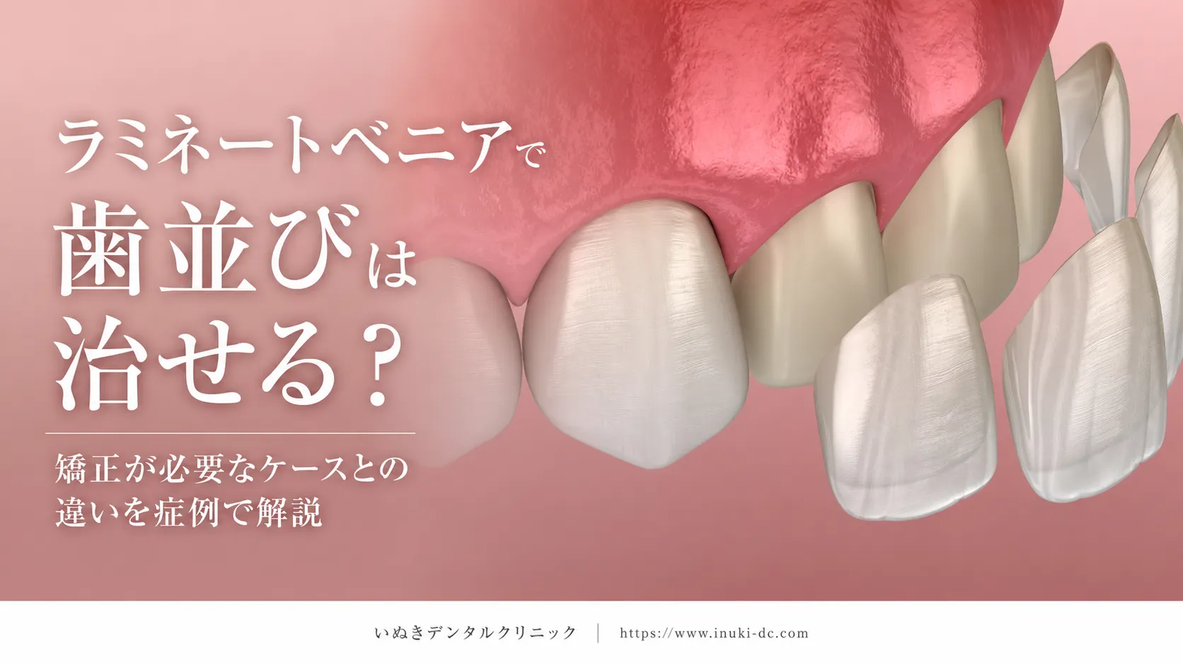 ラミネートベニアで歯並びは治せる?矯正が必要なケースとの違いを症例で解説