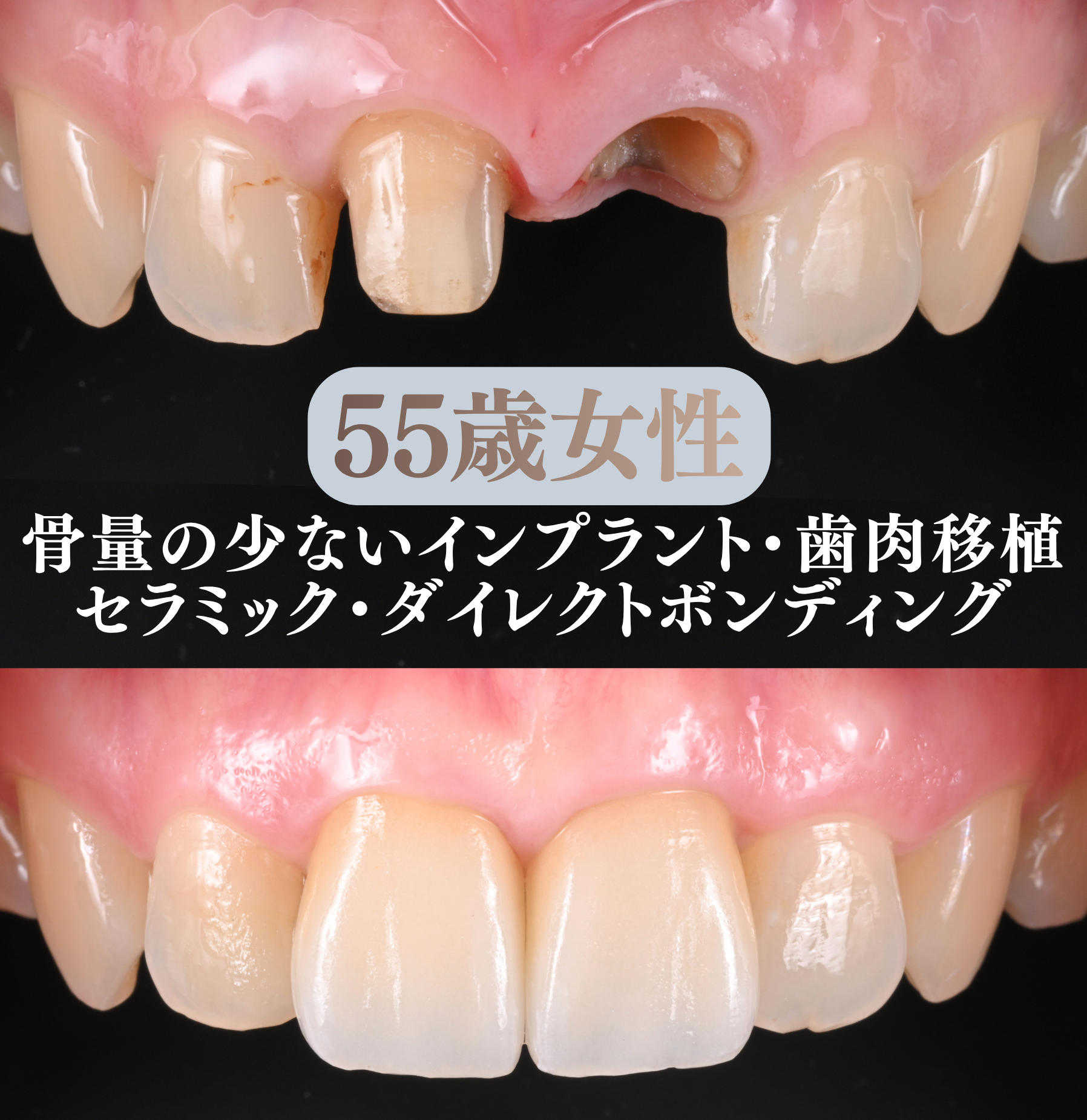 インプラント・セラミック・ダイレクトボンディングによる前歯の審美症例
