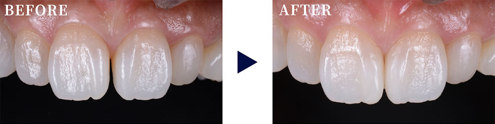 正中離開（前歯のすきっ歯）をダイレクトボンディングで改善した症例