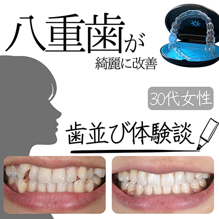 八重歯がきれいに改善