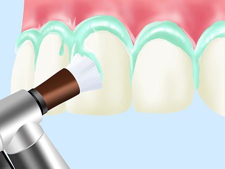 PMTC(専門家による歯のクリーニング)