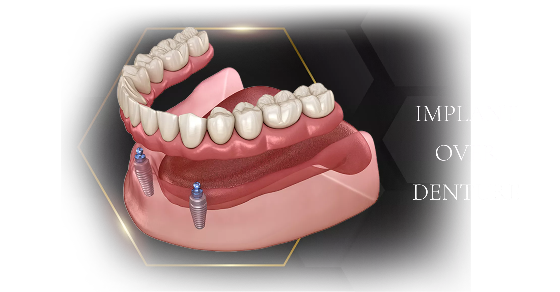 implant