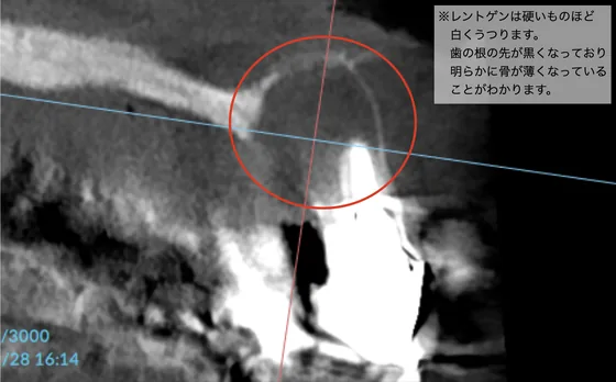 治療前のCT画像：前歯の根尖に大きな黒い影（根尖病変）が見える
