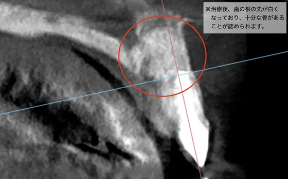 治療後のCT画像：根尖病変が治り、根の先に骨が回復している